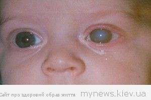 child.glaukoma